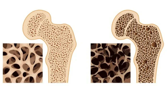osteoporose-dr-felipe-bessa-1024x531