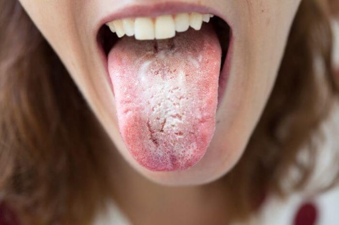 problemas-na-boca-indicam-doencas-graves-candidiase